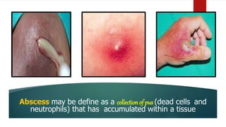 Abscess may be define as a collectionof pus (dead cells and
neutrophils) that has accumulated within a tissue
 