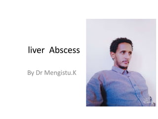 liver Abscess
By Dr Mengistu.K
 