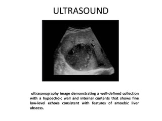 ULTRASOUND
ultrasonography image demonstrating a well-defined collection
with a hypoechoic wall and internal contents that shows fine
low-level echoes consistent with features of amoebic liver
abscess.
 