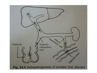 Liver Abscess and its management modalities.pptx