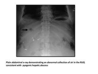 Plain abdominal x-ray demonstrating an abnormal collection of air in the RUQ
consistent with pyogenic hepatic abscess
 