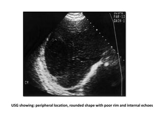 USG showing: peripheral location, rounded shape with poor rim and internal echoes
 