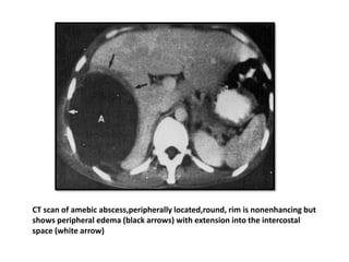 CT scan of amebic abscess,peripherally located,round, rim is nonenhancing but
shows peripheral edema (black arrows) with extension into the intercostal
space (white arrow)
 