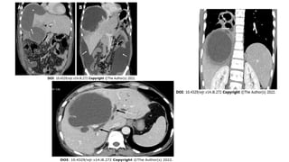 liver abscess with management and classification | PPTX