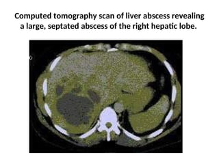 Comprehensive Overview of Pyogenic and Amebic Liver Abscesses ...