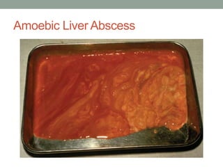 Amoebic Liver Abscess
 