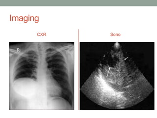 Imaging
CXR Sono
 