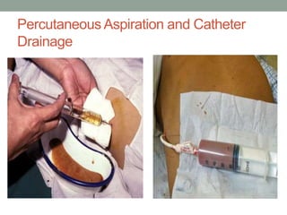 Percutaneous Aspiration and Catheter
Drainage
 