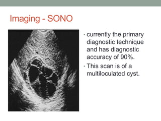 Imaging - SONO
• currently the primary
diagnostic technique
and has diagnostic
accuracy of 90%.
• This scan is of a
multiloculated cyst.
 