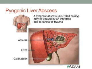 Pyogenic Liver Abscess
 