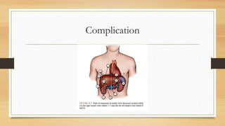 Complication
 