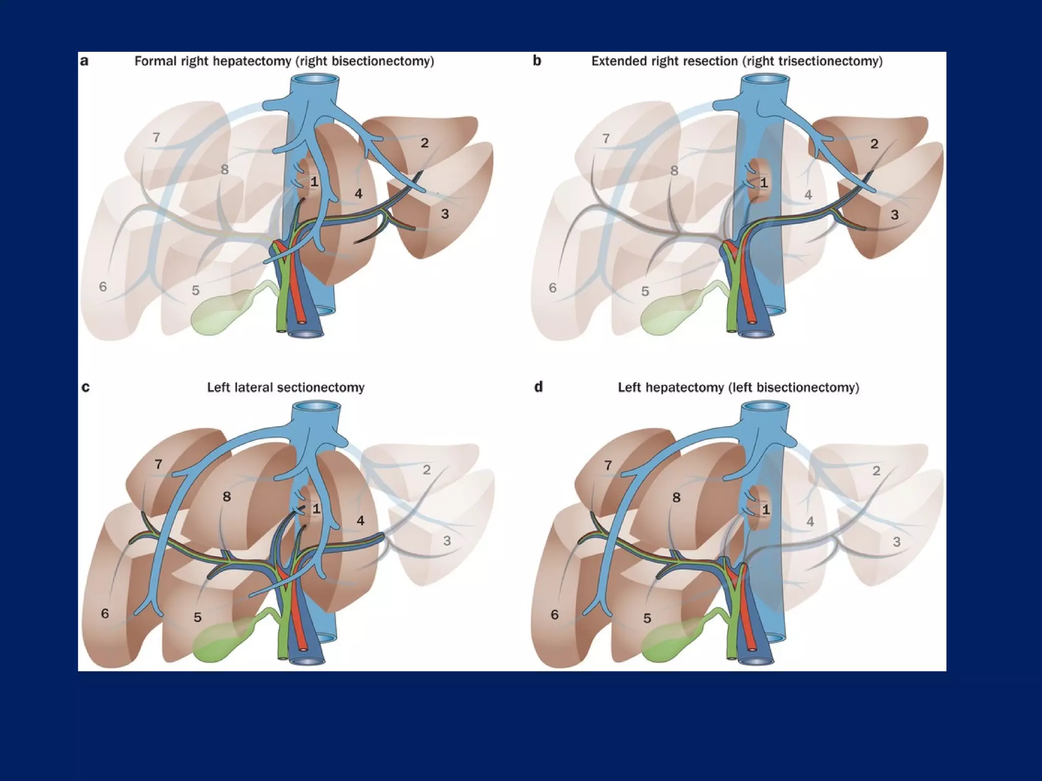 Surgical Anatomy of the Liver : Ηepatectomies - Dimitris P. Korkolis | PPT