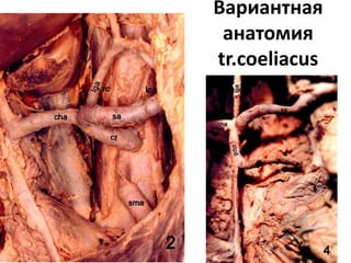 Вариантная
анатомия
tr.coeliacus
 