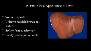 • Smooth capsule
• Uniform reddish-brown cut
surface
• Soft to firm consistency
• Barely visible portal tracts
Normal Gross Appearance of Liver
 