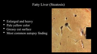 Fatty Liver (Steatosis)
• Enlarged and heavy
• Pale yellow color
• Greasy cut surface
• Most common autopsy finding
 