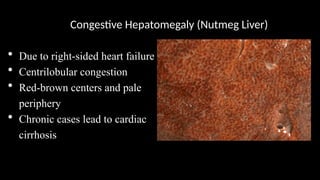 Congestive Hepatomegaly (Nutmeg Liver)
• Due to right-sided heart failure
• Centrilobular congestion
• Red-brown centers and pale
periphery
• Chronic cases lead to cardiac
cirrhosis
 
