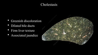 Cholestasis
• Greenish discoloration
• Dilated bile ducts
• Firm liver texture
• Associated jaundice
 