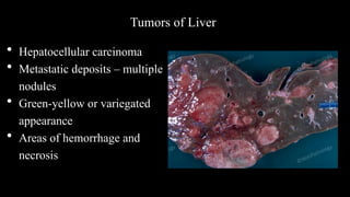 Tumors of Liver
• Hepatocellular carcinoma
• Metastatic deposits – multiple
nodules
• Green-yellow or variegated
appearance
• Areas of hemorrhage and
necrosis
 