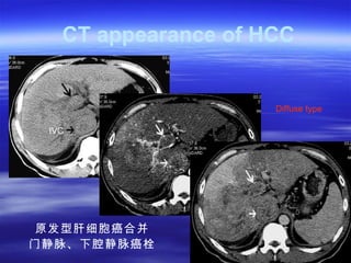 Liver,bile duct,pancreas and spleen | PPT