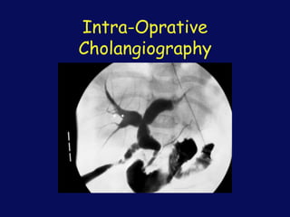 Intra-Oprative
Cholangiography
 