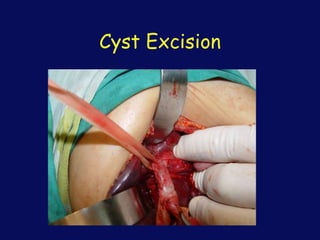Cyst Excision
 