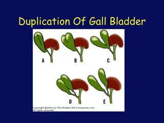 Duplication Of Gall Bladder
 
