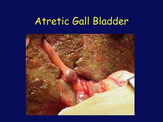 Atretic Gall Bladder
 