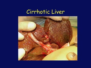 Cirrhotic Liver
 