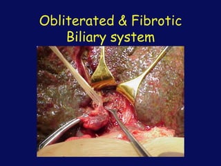 Obliterated & Fibrotic
Biliary system
 