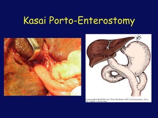 Kasai Porto-Enterostomy
 