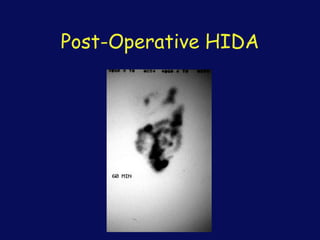 Post-Operative HIDA
 
