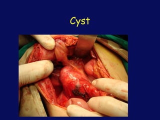 Cyst
 