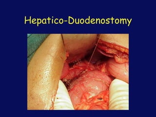 Hepatico-Duodenostomy
 