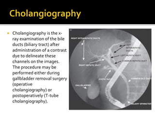  Cholangiography is the x-
ray examination of the bile
ducts (biliary tract) after
administration of a contrast
dye to delineate these
channels on the images.
The procedure may be
performed either during
gallbladder removal surgery
(operative
cholangiography) or
postoperatively (T-tube
cholangiography).
 