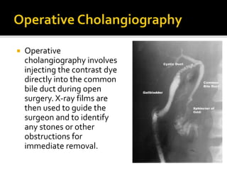  Operative
cholangiography involves
injecting the contrast dye
directly into the common
bile duct during open
surgery. X-ray films are
then used to guide the
surgeon and to identify
any stones or other
obstructions for
immediate removal.
 