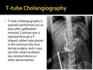  T-tube cholangiography is
typically performed 5 to 10
days after gallbladder
removal. Contrast dye is
injected through aT-
shaped rubber tube placed
in the common bile duct
during surgery, and x-rays
are then taken to detect
any residual stones or
other abnormalities
 