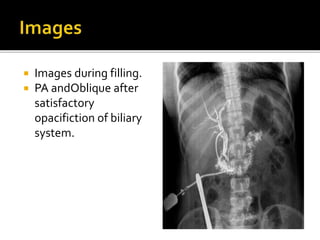  Images during filling.
 PA andOblique after
satisfactory
opacifiction of biliary
system.
 