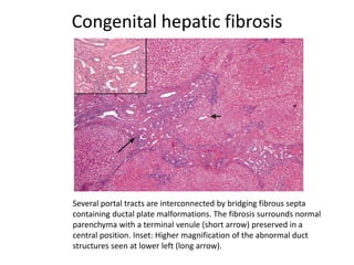 Congenital hepatic fibrosis
Several portal tracts are interconnected by bridging fibrous septa
containing ductal plate malformations. The fibrosis surrounds normal
parenchyma with a terminal venule (short arrow) preserved in a
central position. Inset: Higher magnification of the abnormal duct
structures seen at lower left (long arrow).
 