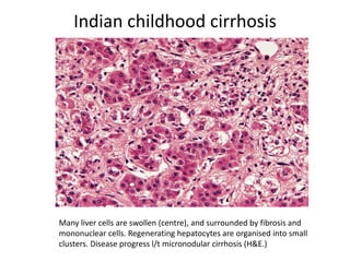Indian childhood cirrhosis
Many liver cells are swollen (centre), and surrounded by fibrosis and
mononuclear cells. Regenerating hepatocytes are organised into small
clusters. Disease progress l/t micronodular cirrhosis (H&E.)
 
