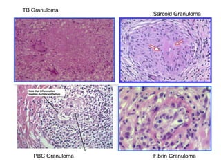 TB Granuloma
Sarcoid Granuloma
PBC Granuloma Fibrin Granuloma
 