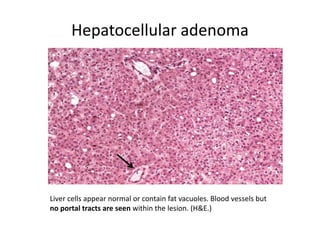 Hepatocellular adenoma
Liver cells appear normal or contain fat vacuoles. Blood vessels but
no portal tracts are seen within the lesion. (H&E.)
 