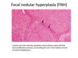 Focal nodular hyperplasia (FNH)
Central scar with arteriole, periphery shows fibrous septa with bile
duct proliferation (arrow), surrounding the scar is the nodule consists
of normal hepotocytes .
 