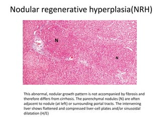 Nodular regenerative hyperplasia(NRH)
This abnormal, nodular growth pattern is not accompanied by fibrosis and
therefore differs from cirrhosis. The parenchymal nodules (N) are often
adjacent to nodule (at left) or surrounding portal tracts. The intervening
liver shows flattened and compressed liver-cell plates and/or sinusoidal
dilatation (H/E)
N
N
 