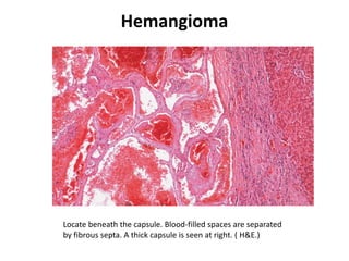 Hemangioma
Locate beneath the capsule. Blood-filled spaces are separated
by fibrous septa. A thick capsule is seen at right. ( H&E.)
 