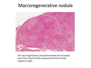 Macroregenerative nodule
This low-magnification view demonstrates the increased
size of the nodule at left compared with the cirrhotic
nodules at right.
 