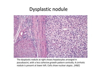 Dysplastic nodule
The dysplastic nodule at right shows hepatocytes arranged in
pseudoacini, with a less cohesive growth pattern centrally. A cirrhotic
nodule is present at lower left. Cells show nuclear atypia , (H&E)
 