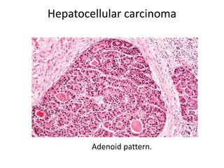Hepatocellular carcinoma
Adenoid pattern.
 