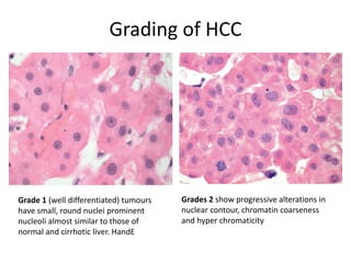 Grading of HCC
Grade 1 (well differentiated) tumours
have small, round nuclei prominent
nucleoli almost similar to those of
normal and cirrhotic liver. HandE
Grades 2 show progressive alterations in
nuclear contour, chromatin coarseness
and hyper chromaticity
 