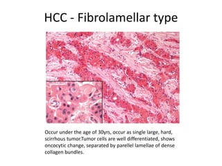 HCC - Fibrolamellar type
Occur under the age of 30yrs, occur as single large, hard,
scirrhous tumor.Tumor cells are well differentiated, shows
oncocytic change, separated by parellel lamellae of dense
collagen bundles.
 