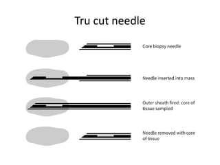 Tru cut needle
 